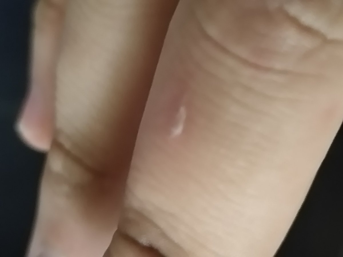 la mega quemadura causada por agua con arroz ggrrraaahhh
