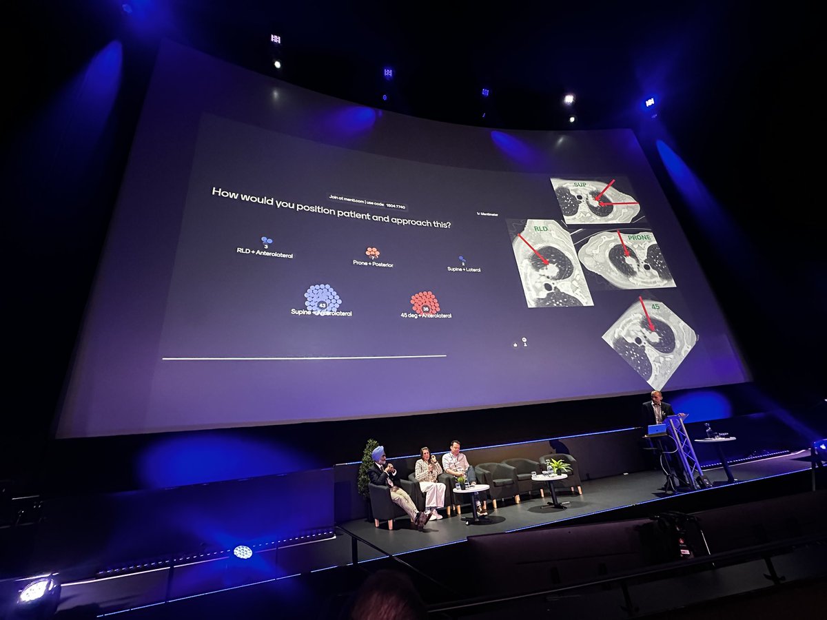 Junior BSTI (@juniorbsti) on Twitter photo 🩻 BSTI ASM 2025 Day 2
🫁 Panel discussion with
<a href="/drasharman/">Anna Sharman</a>, Dr. Joe Barnett and Mr. Maninder Kalkat (Thoracic Surgeon)
Some key takeaways when considering pre surgical biopsy in patients with part solid lesions: 🩻 BSTI ASM 2025 Day 2
🫁 Panel discussion with
<a href="/drasharman/">Anna Sharman</a>, Dr. Joe Barnett and Mr. Maninder Kalkat (Thoracic Surgeon)
Some key takeaways when considering pre surgical biopsy in patients with part solid lesions: