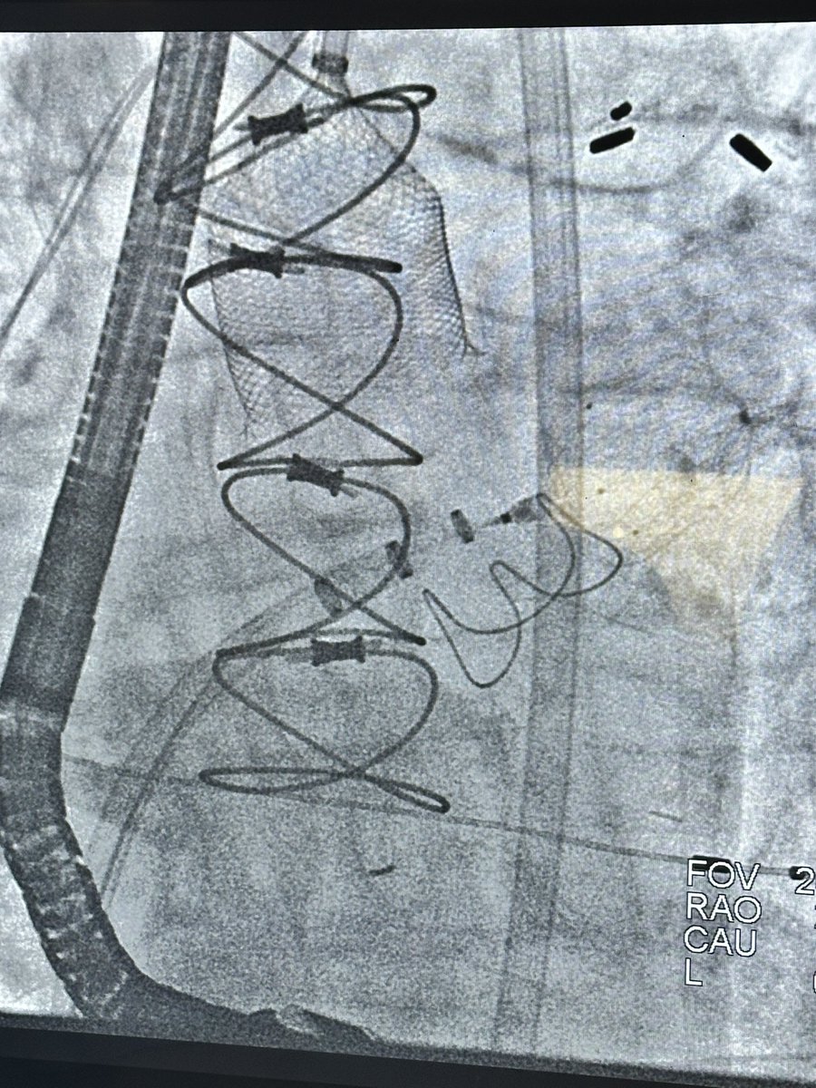 Gennaro Giustino, MD (@g_giustinomd) on Twitter photo Can’t deliver Sentinel during LAAO with appendage thrombus?
No big deal… switch to full embolic protection :)
<a href="/ONOCORvascular/">ŌNŌCOR</a> <a href="/PhilGenereuxMD/">Philippe Genereux</a> <a href="/PedroMDMSc/">Pedro Villablanca MD, MSc, FACC, FSCAI</a> <a href="/AhmadJabri8/">Ahmad Jabri MD , FACC, FSCAI</a> <a href="/fangjonathanx/">Jonathan X Fang, MBBS, FACC, FSCAI</a> <a href="/KKoulogiannis/">Kosta Koulogiannis</a> Can’t deliver Sentinel during LAAO with appendage thrombus?
No big deal… switch to full embolic protection :)
<a href="/ONOCORvascular/">ŌNŌCOR</a> <a href="/PhilGenereuxMD/">Philippe Genereux</a> <a href="/PedroMDMSc/">Pedro Villablanca MD, MSc, FACC, FSCAI</a> <a href="/AhmadJabri8/">Ahmad Jabri MD , FACC, FSCAI</a> <a href="/fangjonathanx/">Jonathan X Fang, MBBS, FACC, FSCAI</a> <a href="/KKoulogiannis/">Kosta Koulogiannis</a>