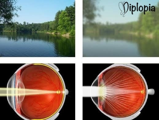diplopia2020's tweet image. Cataracts? There's a Clear Solution

☁️ Cloudy vision? Glare while driving at night? You may have cataracts—and they’re incredibly common as we age.  Learn more about what to watch for: diplopia.co/blog/aging-eye…

#Cataracts #ClearVision #OptometryCare #Diplopia #RichlandCenter