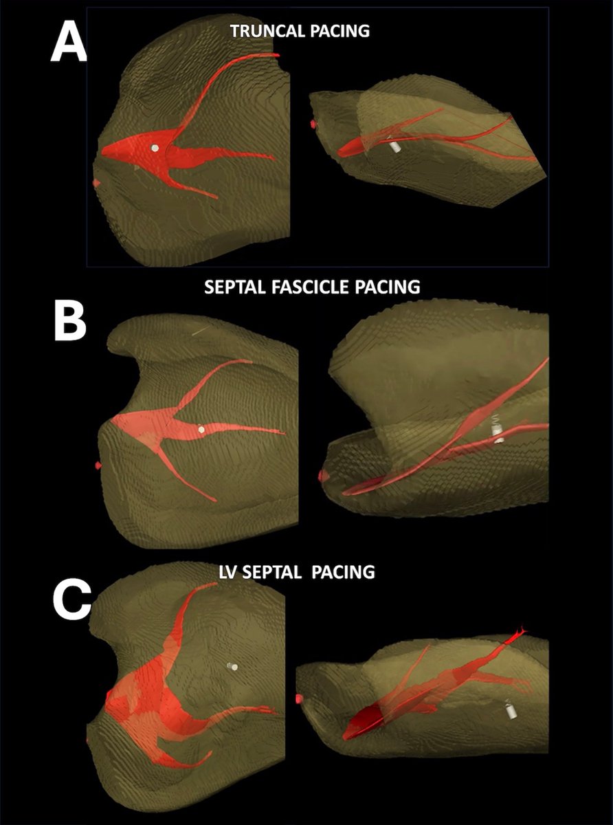 Margarida Pujol Lopez (@margaridapujol) on Twitter photo LVEF responds significantly better to shorter LH(Lead to His) and greater LE(Lead - endoc).
Shorter LH led to significantly greater absolute LVEF response of 0.25% for each 1 mm, p= 0.006
<a href="/shunmug_his_mdu/">Shunmuga Sundaram Ponnusamy</a> A. Pillai <a href="/KennethEllenbo1/">Kenneth Ellenbogen</a> <a href="/pvijayaraman1/">hisdoc</a> ❤️👏
heartrhythmjournal.com/article/S1547-… LVEF responds significantly better to shorter LH(Lead to His) and greater LE(Lead - endoc).
Shorter LH led to significantly greater absolute LVEF response of 0.25% for each 1 mm, p= 0.006
<a href="/shunmug_his_mdu/">Shunmuga Sundaram Ponnusamy</a> A. Pillai <a href="/KennethEllenbo1/">Kenneth Ellenbogen</a> <a href="/pvijayaraman1/">hisdoc</a> ❤️👏
heartrhythmjournal.com/article/S1547-…