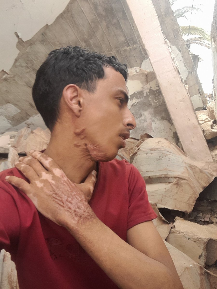 Olive ๐ฟ (@oliveegirl) on Twitter photo <a href="/BahaaEdani/">Hamza from Gaza ๐ต๐ธ๐</a> is a ๐๐ช๐ง๐ฃ๐จ ๐๐ฃ๐๐ช๐ง๐ฎ ๐ซ๐๐๐ฉ๐๐ข.
He survived the bombs, but not without scarsโdeep, painful, and permanent.
๐ฝ๐ ๐ฉ๐๐ ๐ข๐๐ง๐๐ฎ ๐๐๐ฏ๐ ๐๐จ ๐๐๐ฃ๐๐๐.
Donate: chuffed.org/project/burn-wโฆ
๐๐ ๐ญ๐ก๐ ๐ฆ๐๐ซ๐๐ฒ ๐๐๐ณ๐ ๐ข๐ฌ ๐๐๐ง๐ข๐๐! <a href="/BahaaEdani/">Hamza from Gaza ๐ต๐ธ๐</a> is a ๐๐ช๐ง๐ฃ๐จ ๐๐ฃ๐๐ช๐ง๐ฎ ๐ซ๐๐๐ฉ๐๐ข.
He survived the bombs, but not without scarsโdeep, painful, and permanent.
๐ฝ๐ ๐ฉ๐๐ ๐ข๐๐ง๐๐ฎ ๐๐๐ฏ๐ ๐๐จ ๐๐๐ฃ๐๐๐.
Donate: chuffed.org/project/burn-wโฆ
๐๐ ๐ญ๐ก๐ ๐ฆ๐๐ซ๐๐ฒ ๐๐๐ณ๐ ๐ข๐ฌ ๐๐๐ง๐ข๐๐!