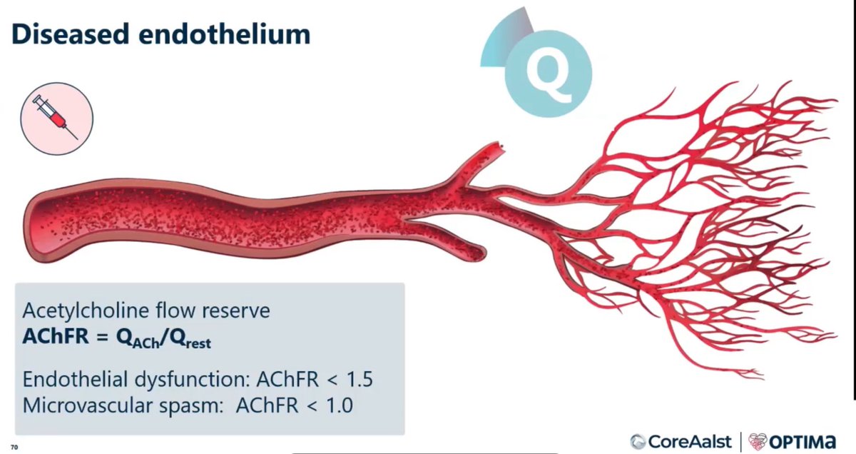 Zille Huma (@zill_cardio) on Twitter photo #TPC2025
<a href="/OptimaCTO/">Optima Education</a>
#ANOCA
#AchFR
💥 Acetylcholine Protocol & Cut-off Values of Acetylcholine Flow Reserve for Dx of ANOCA 👇 #TPC2025
<a href="/OptimaCTO/">Optima Education</a>
#ANOCA
#AchFR
💥 Acetylcholine Protocol & Cut-off Values of Acetylcholine Flow Reserve for Dx of ANOCA 👇