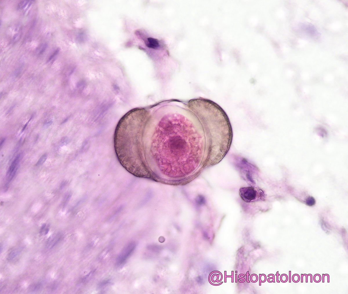 Histopatolomon's tweet image. Pine pollen is one of the most common pollens seen on slides in pathology labs, especially when the windows are left open. It may or may not be stained, depending on when it falls. #pine @yro854 @tlabiano #pollen #artifact @lara_pijuan @edusqo @ijexpafo