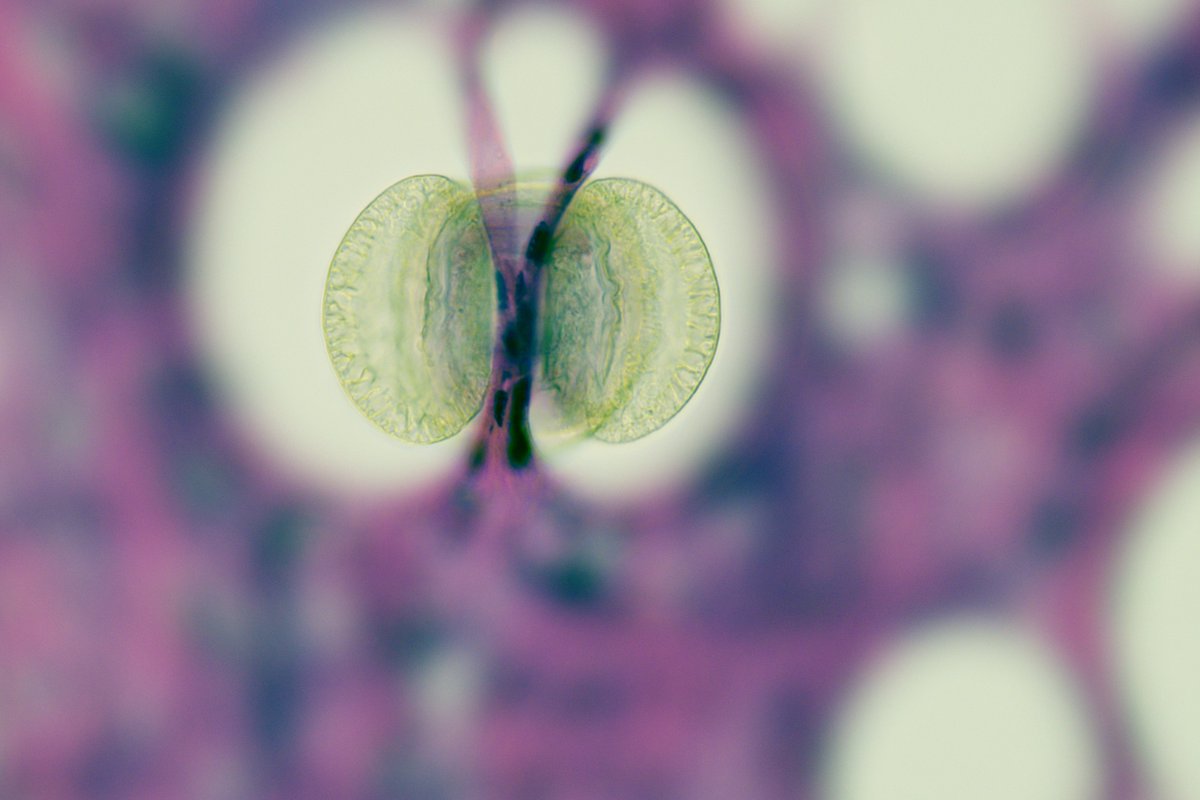 Histopatolomon's tweet image. Pine pollen is one of the most common pollens seen on slides in pathology labs, especially when the windows are left open. It may or may not be stained, depending on when it falls. #pine @yro854 @tlabiano #pollen #artifact @lara_pijuan @edusqo @ijexpafo