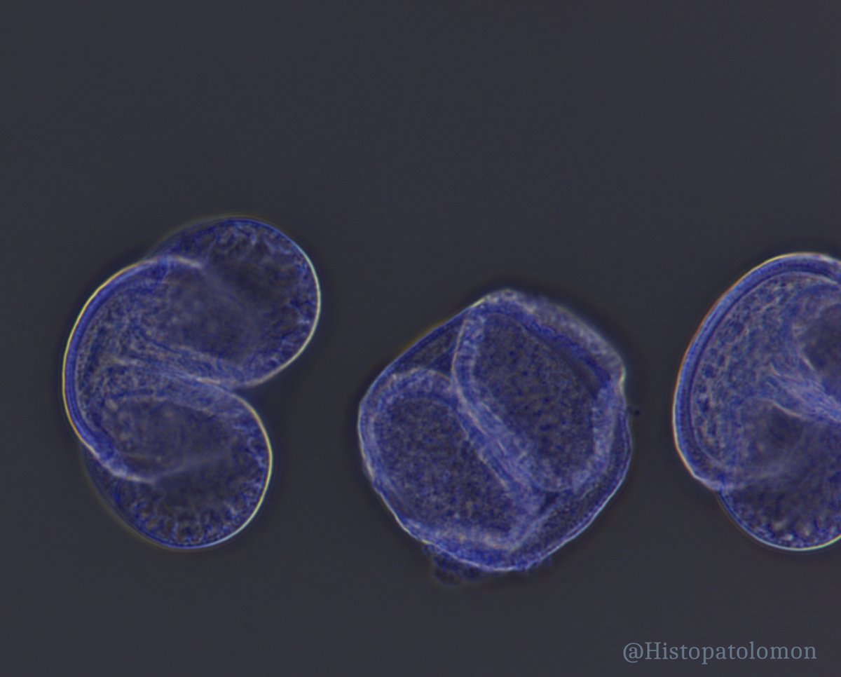 Histopatolomon's tweet image. Pine pollen is one of the most common pollens seen on slides in pathology labs, especially when the windows are left open. It may or may not be stained, depending on when it falls. #pine @yro854 @tlabiano #pollen #artifact @lara_pijuan @edusqo @ijexpafo
