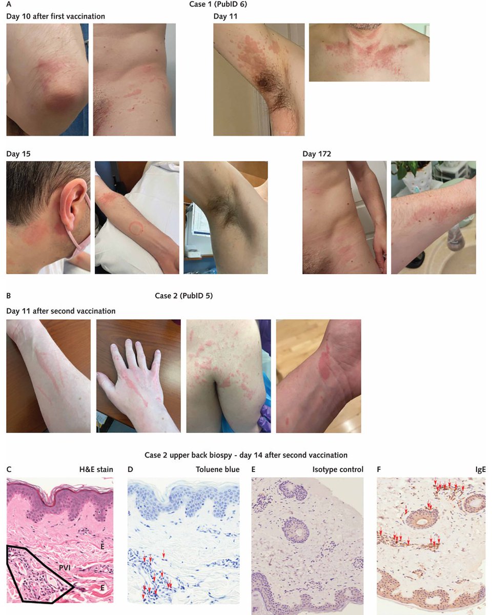 Annals of Int Med (@annalsofim) on Twitter photo A safety analysis of #mRNA vaccination in a phase 1, randomized, open-label clinical trial evaluated the safety and tolerability of three investigational HIV-1 trimer mRNA vaccines. The study vaccines were found to be generally safe and tolerable. However, the researchers A safety analysis of #mRNA vaccination in a phase 1, randomized, open-label clinical trial evaluated the safety and tolerability of three investigational HIV-1 trimer mRNA vaccines. The study vaccines were found to be generally safe and tolerable. However, the researchers