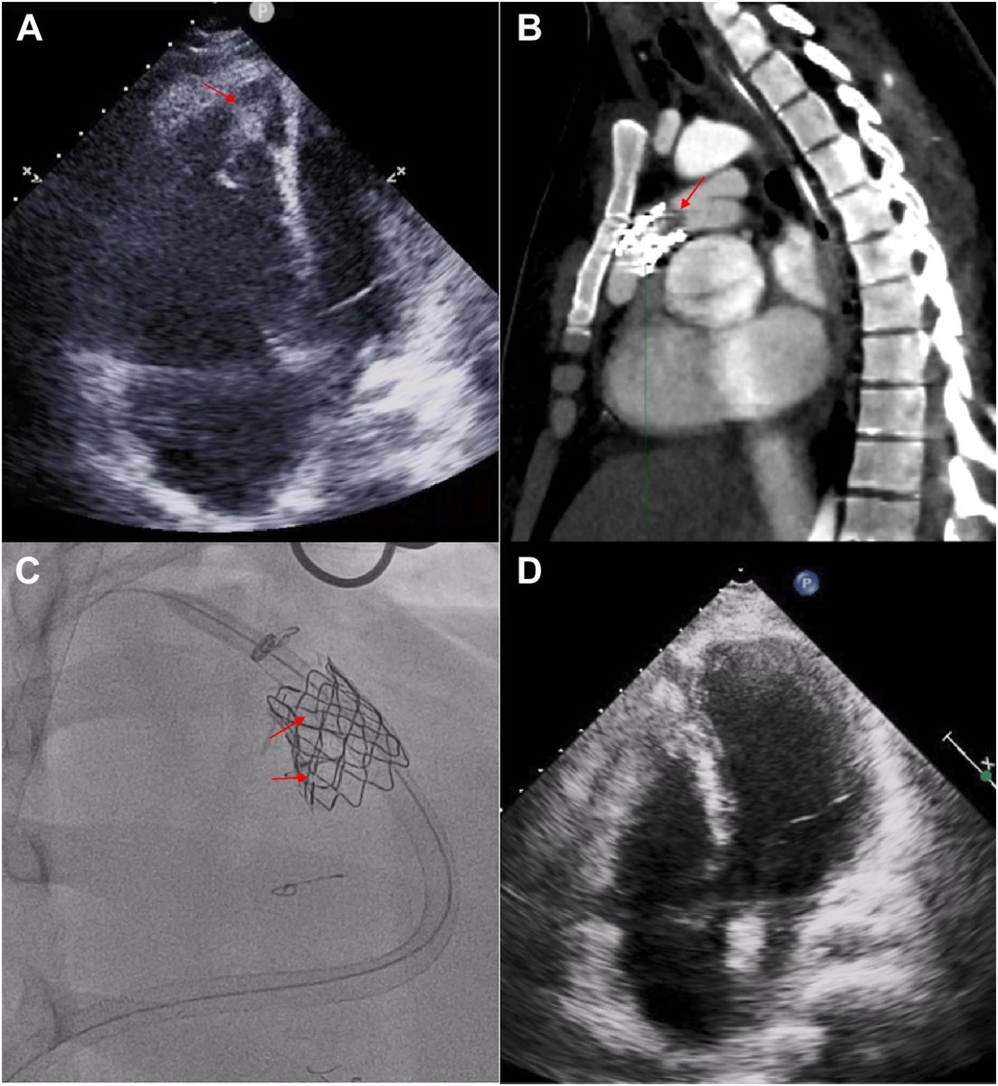 🫀 ECMO, aspiration, valvuloplasty and surgery to treat #endocarditis on a pulmonary prosthesis — read about it here! ⬇️
onlinecjc.ca/article/S0828-…
#ECMO #CJC