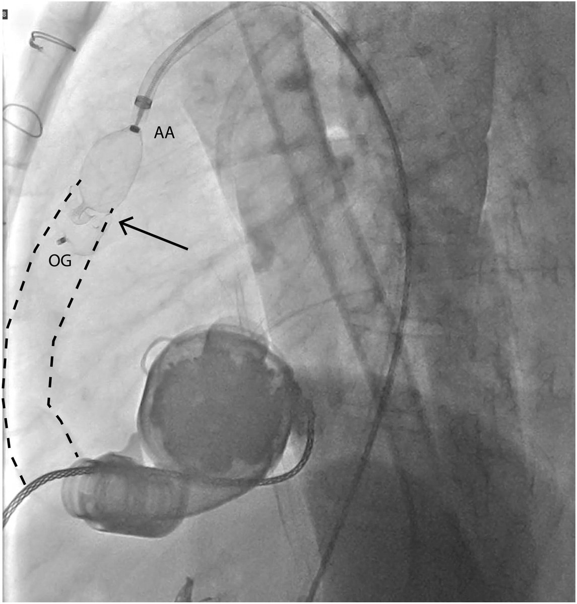 🔎 Exploring the use of #LVAD as a bridge-to-recovery strategy in alcoholic #cardiomyopathy. Discover how sustained myocardial improvement was achieved ⬇️
onlinecjc.ca/article/S0828-…
#CJC #OpenAccess