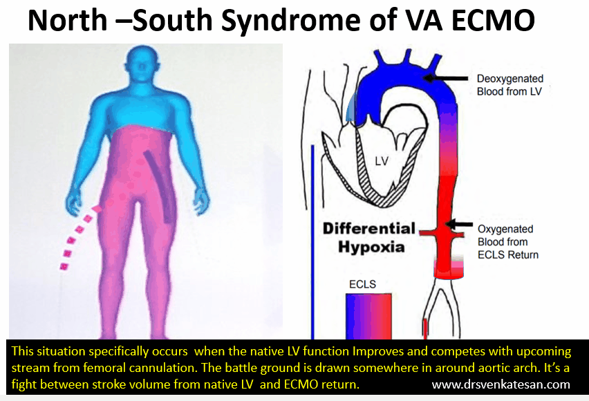 #CardioNuggets

North-South Syndrome on VA-ECMO:

🧠💔 Brain &amp; heart get hypoxic blood (native, poorly oxygenated).

🦵 Rest of body gets well-oxygenated ECMO blood.

🚨 Look for low right arm sats!

🔧 Solutions: Improve lungs, ↑ ECMO flow, axillary cannula, or VAV-ECMO.