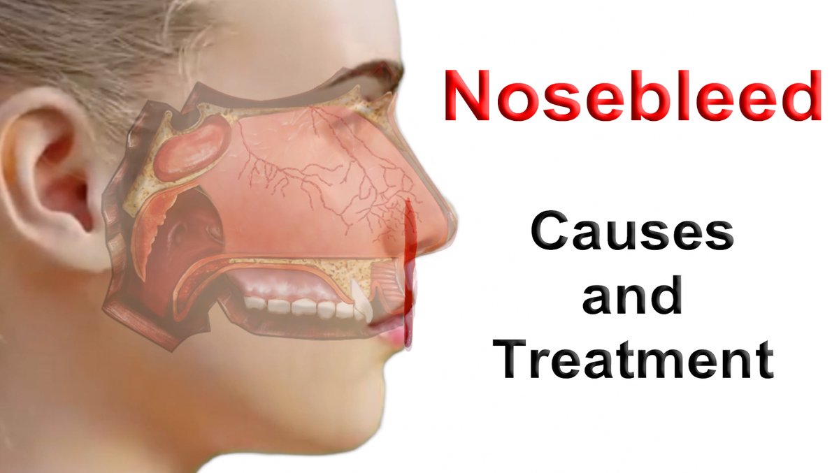 Nosebleed Causes and Treatment youtu.be/giDZZrxcjog