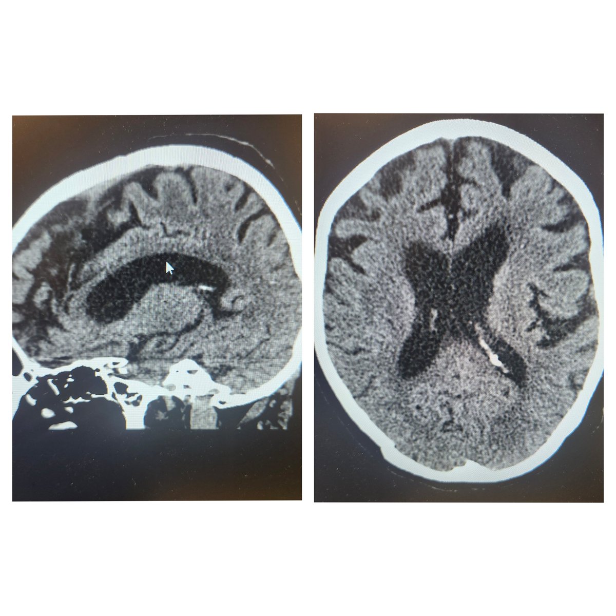 MDLINEHEALTH's tweet photo. Patient 64 presented with rapidly progressing memory loss and ataxia. A CT scan revealed dilated lateral ventricles, and laboratory tests showed a vitamin B12 deficiency. The differential diagnosis included normal pressure hydrocephalus (NPH) and subacute combined degeneration.

We performed a lumbar puncture (Opening pressure 32) and initiated IV Cyanocobalamin treatment. The patient subsequently showed clinical improvement. However, it remains unclear whether the improvement was due to the LP (supporting NPH) or the B12 administration (supporting subacute combined degeneration). 😆 

Additionally, the patient had an equivocal syphilis serology, raising concern for neurosyphilis. However, CSF VDRL was negative.
