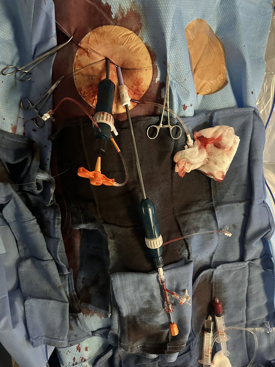 Gennaro Giustino, MD (@g_giustinomd) on Twitter photo <a href="/TheNarulaSeries/">Arvin Narula</a> <a href="/ONOCORvascular/">ŌNŌCOR</a> <a href="/PhilGenereuxMD/">Philippe Genereux</a> <a href="/PedroMDMSc/">Pedro Villablanca MD, MSc, FACC, FSCAI</a> <a href="/AhmadJabri8/">Ahmad Jabri MD , FACC, FSCAI</a> <a href="/fangjonathanx/">Jonathan X Fang, MBBS, FACC, FSCAI</a> <a href="/KKoulogiannis/">Kosta Koulogiannis</a> 17 Fr TruSteer inserted sheathless in RFA and pre-closed <a href="/TheNarulaSeries/">Arvin Narula</a> <a href="/ONOCORvascular/">ŌNŌCOR</a> <a href="/PhilGenereuxMD/">Philippe Genereux</a> <a href="/PedroMDMSc/">Pedro Villablanca MD, MSc, FACC, FSCAI</a> <a href="/AhmadJabri8/">Ahmad Jabri MD , FACC, FSCAI</a> <a href="/fangjonathanx/">Jonathan X Fang, MBBS, FACC, FSCAI</a> <a href="/KKoulogiannis/">Kosta Koulogiannis</a> 17 Fr TruSteer inserted sheathless in RFA and pre-closed