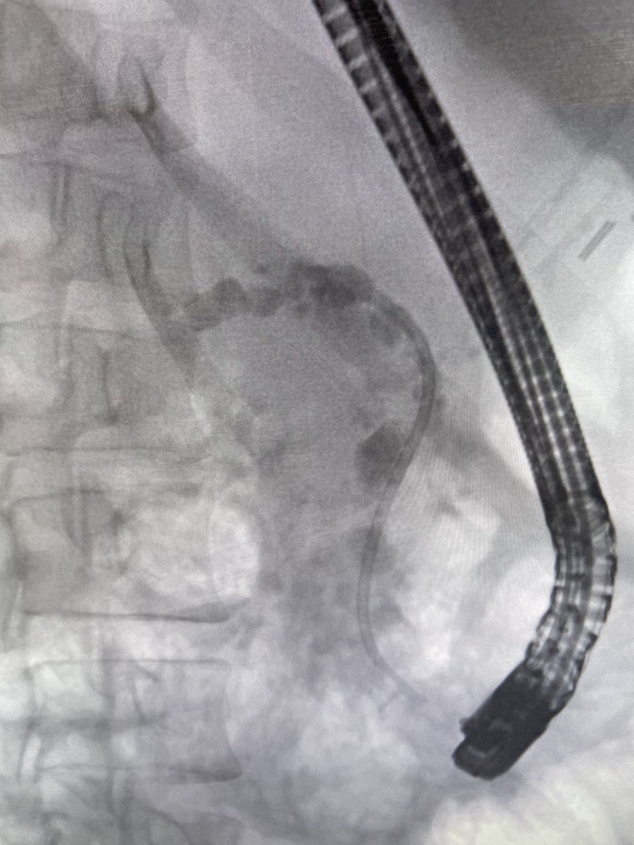 Douglas G. Adler MD, FASGE, FACG, AGAF (@douglasadlermd) on Twitter photo More hard-core chronic pancreatitis. Pancreatic sphincterotomy. Many stones removed. Many stones to go! #gitwitter #pancreas <a href="/asge/">Aslak Gottlieb</a> <a href="/GIE_Journal/">GIE</a> <a href="/NEndoscopy/">Prof John Leeds</a> <a href="/NealMehtaMD/">Neal Mehta</a> <a href="/EUSandEndoscopy/">Scot Michael Lewey</a> More hard-core chronic pancreatitis. Pancreatic sphincterotomy. Many stones removed. Many stones to go! #gitwitter #pancreas <a href="/asge/">Aslak Gottlieb</a> <a href="/GIE_Journal/">GIE</a> <a href="/NEndoscopy/">Prof John Leeds</a> <a href="/NealMehtaMD/">Neal Mehta</a> <a href="/EUSandEndoscopy/">Scot Michael Lewey</a>