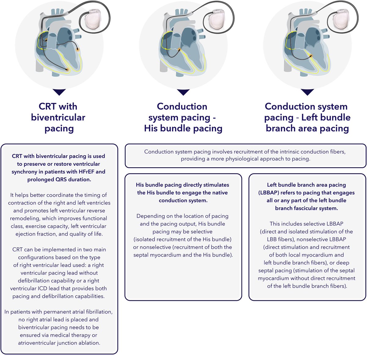 Cardiac rhythm devices in #HFrEF : Practical guidance on patient referral, device selection, implant timing and patient-centred follow-up. 

This  #EJHF expert consensus document discusses the latest evidence on the role of CRM devices in reducing #HFrEF mortality and morbidity .