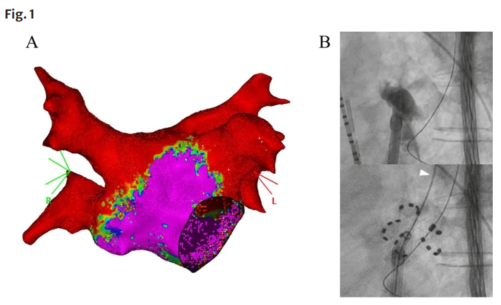 🚨Latest #FreeRead in <a href="/JICE_EP/">JICE</a> 

Unintended Isolation of the Left Atrial Appendage: a Rare Complication of PFA

🧐📖rdcu.be/ejWzL

by Yuki Takai, Yuya Nakamura, Taku Asano &amp; Toshiro Shinke

#EPeeps