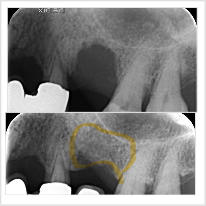 progresdent's tweet photo. The power of laser dentistry. Our case here shows bone regeneration after an infected tooth was removed. Waterlase I plus laser was used to disinfect the site and 6 months later, we have bone present. Now time for a dental implant. Expert treatment by Dr Nissit Patel #waterlase https://t.co/KOLzhhw8K5