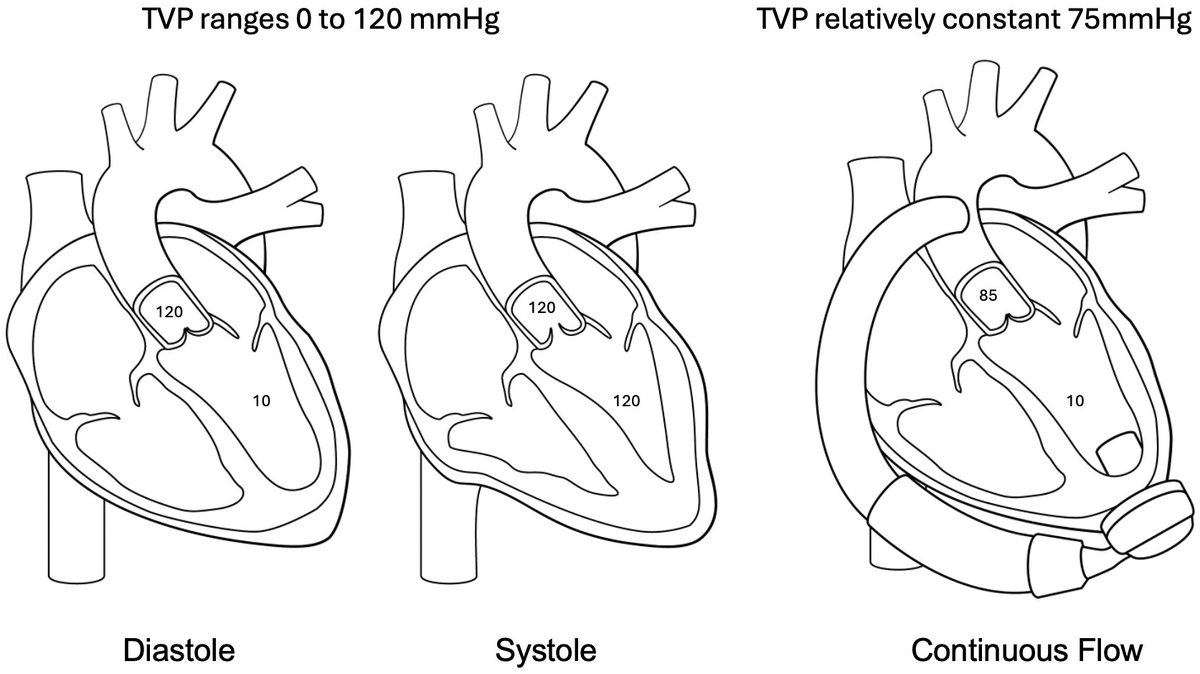 Susie Sun (@susiesu11733465) on Twitter photo #RCM Fresh Review Article:
"Structural Heart Interventions in Patients with Left #Ventricular Assist #Devices"
✍️from <a href="/PuviSeshiah/">Puvi Seshiah</a>, <a href="/djkereiakes/">Dean Kereiakes, M.D.</a>, <a href="/GFEMD/">Greg Egnaczyk</a> et al.
#LVAD #heartfailure #HF #valvular #transcatheter #interventions
🧐Welcome to read it:
imrpress.com/journal/RCM/26… #RCM Fresh Review Article:
"Structural Heart Interventions in Patients with Left #Ventricular Assist #Devices"
✍️from <a href="/PuviSeshiah/">Puvi Seshiah</a>, <a href="/djkereiakes/">Dean Kereiakes, M.D.</a>, <a href="/GFEMD/">Greg Egnaczyk</a> et al.
#LVAD #heartfailure #HF #valvular #transcatheter #interventions
🧐Welcome to read it:
imrpress.com/journal/RCM/26…