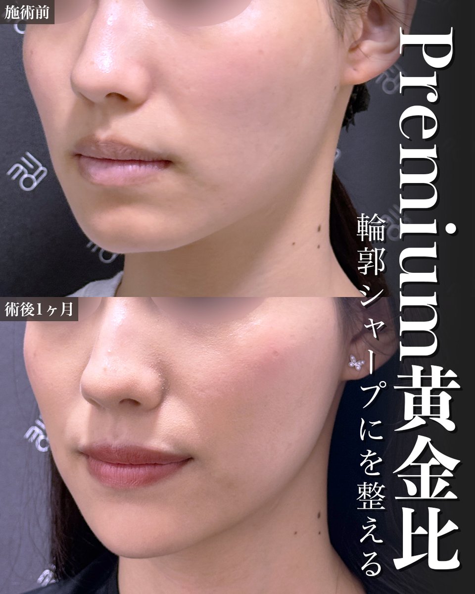 骨を切らずに輪郭を整える

糸リフト、ヒアルロン酸、ボトックスのみでこの変化☝️