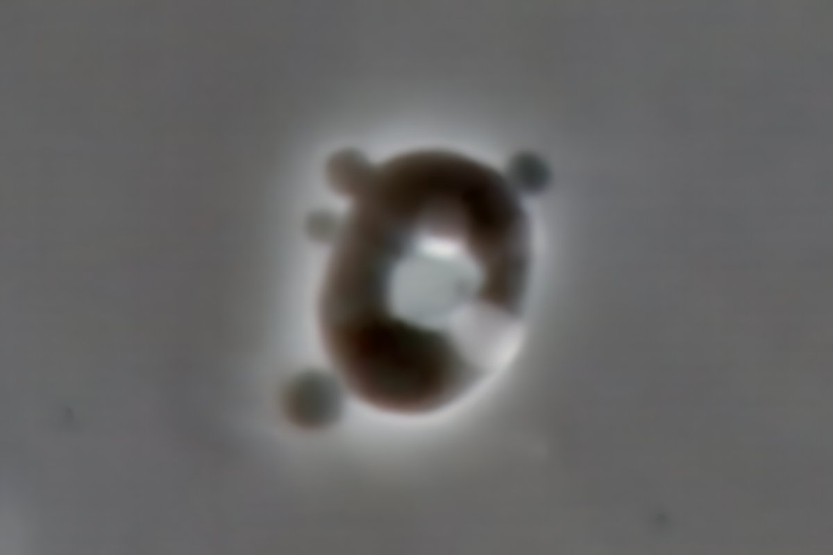 Acanthocyte - darkfield, unstained - cropped from original x1000 - from case of suspected hydralazine-induced vasculitis - #UrineMicroscopy #UrinarySediment