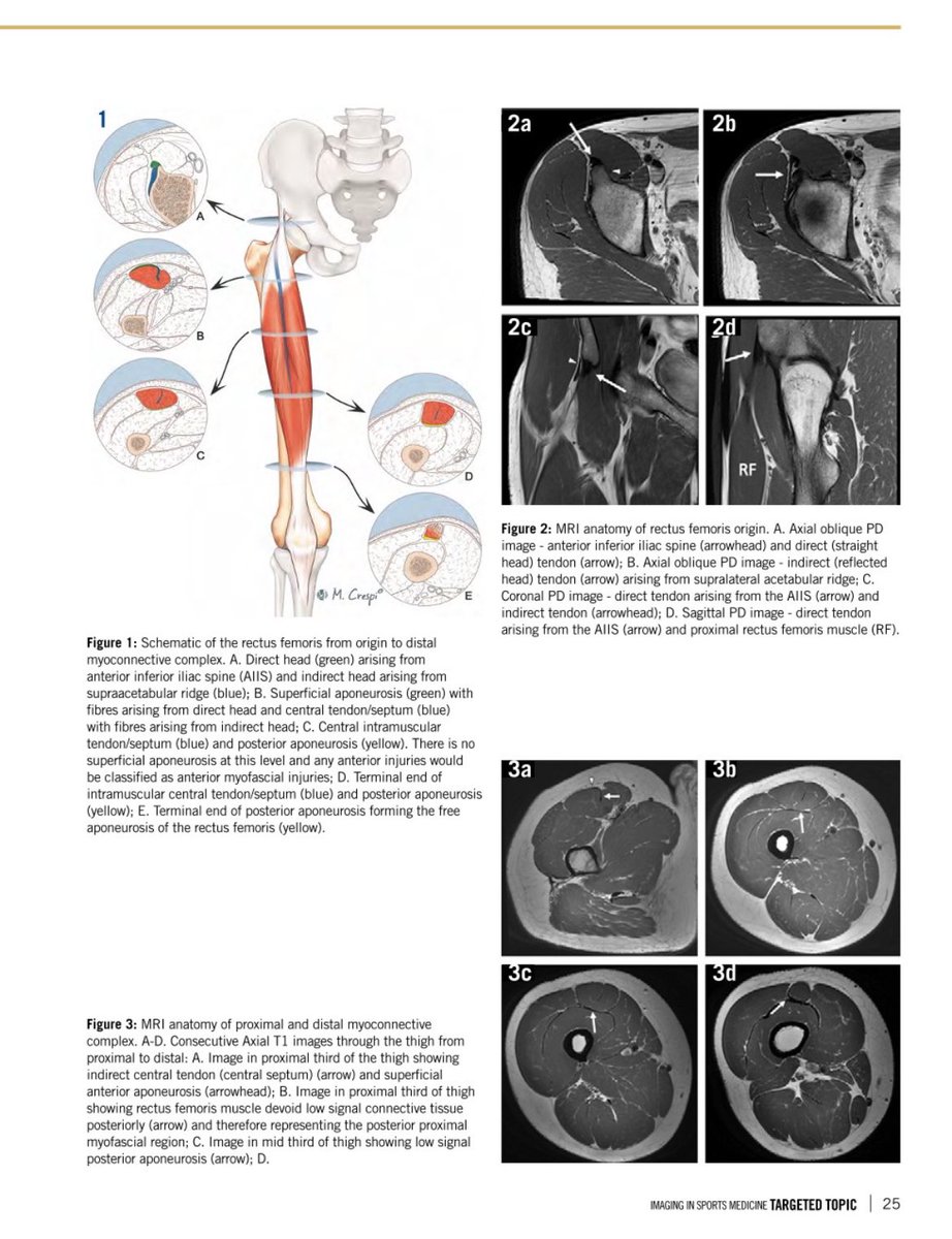 Gulraiz Ahmad (@drgulraizahmad) on Twitter photo All things rectus femoris. Many thanks to <a href="/MarceloBordalo/">Marcelo Bordalo</a> <a href="/Aspetar/">Aspetar سبيتار</a> <a href="/carlespedret/">carlespedret</a> <a href="/brucebforster/">Bruce Forster</a> <a href="/ManchesterMSK/">ManchesterMSKImaging</a>
Open access available at: journal.aspetar.com/en/archive/vol… All things rectus femoris. Many thanks to <a href="/MarceloBordalo/">Marcelo Bordalo</a> <a href="/Aspetar/">Aspetar سبيتار</a> <a href="/carlespedret/">carlespedret</a> <a href="/brucebforster/">Bruce Forster</a> <a href="/ManchesterMSK/">ManchesterMSKImaging</a>
Open access available at: journal.aspetar.com/en/archive/vol…