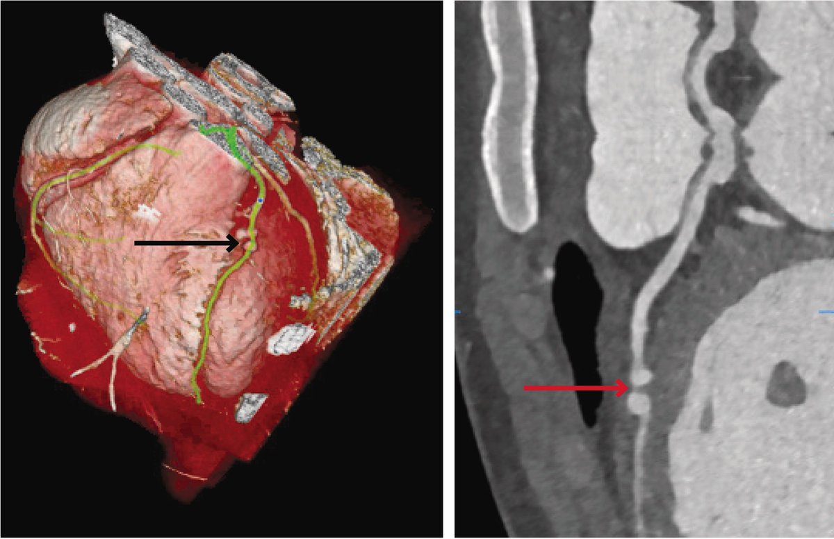 1/ 🩺 Stab-induced chest trauma can lead to rare but serious coronary complications. 🚑 Our patient, a 16-year-old boy, presented with chest pain post-stabbing, initially treated for hemothorax. 🔍 Persistent symptoms prompted deeper evaluation, revealing 2 LAD artery