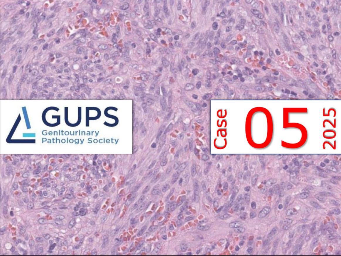 GU Pathology Society (GUPS) (@gu_path_society) on Twitter photo The <a href="/GU_Path_Society/">GU Pathology Society (GUPS)</a> Case of the Week:
47-year-old man with penile lesion
gupathsociety.org/interesting-ca…
Send your cases to gupathsociety.org/submit-an-inte…
FB: GU Pathology Society
IG: gu_pathology_society
LinkedIN: GUPS Society The <a href="/GU_Path_Society/">GU Pathology Society (GUPS)</a> Case of the Week:
47-year-old man with penile lesion
gupathsociety.org/interesting-ca…
Send your cases to gupathsociety.org/submit-an-inte…
FB: GU Pathology Society
IG: gu_pathology_society
LinkedIN: GUPS Society