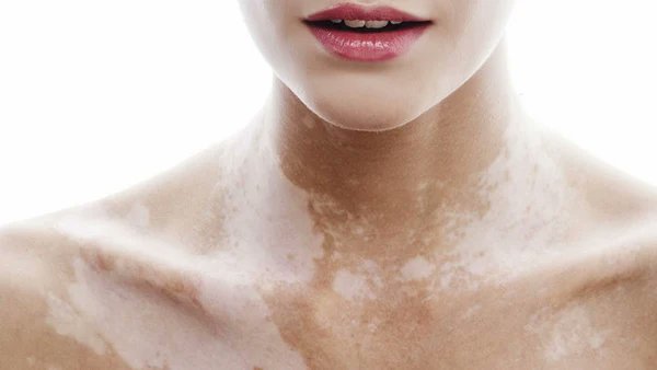 redvitiligo's tweet image. Lo que debes saber sobre esta enfermedad incurable (VITÍLIGO) que probablemente nunca has oído hablar.
Sigue enterándote aquí:
👉 tinyurl.com/52bnzrxt
#Vitíligo #VitiligoMexico #tratamientosparaelvitiligo #vitiligo #manchasblancasenpiel #leucoderma #VitiligoNoEsContagioso