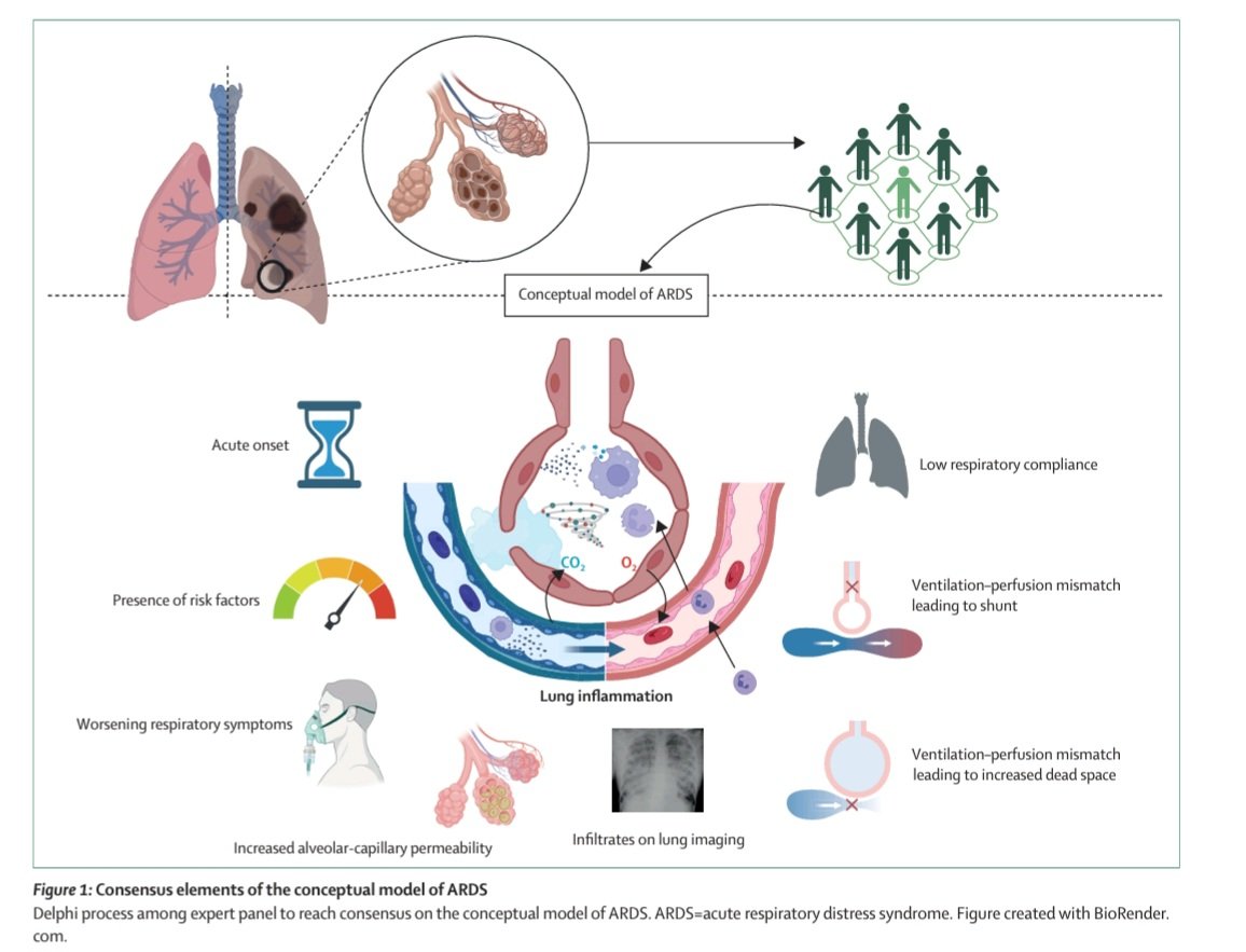 Could it be time to move beyond traditional definitions of ARDS and rethink our approach to heterogeneity in ARDS care and research?

📖 Read it here 
authors.elsevier.com/a/1l0Mh7tFB1bV…

🙏 Huge thanks to my brilliant co-authors for their insight and collaboration.