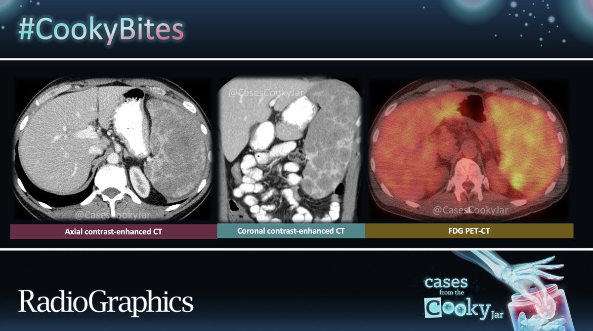Cases From the Cooky Jar (@casescookyjar) on Twitter photo 50M with low platelet count at wellness check 🩺
Physical examination found an enlarged spleen.
Diagnosis 🕵️♂️❓
We’ll post the answer in 24h. Share companion cases with us using #CookyBites #215. We will RT the best cases!
#RGphx <a href="/cookyscan1/">Cooky Menias</a> <a href="/RadioGraphics/">RadioGraphics</a> 50M with low platelet count at wellness check 🩺
Physical examination found an enlarged spleen.
Diagnosis 🕵️♂️❓
We’ll post the answer in 24h. Share companion cases with us using #CookyBites #215. We will RT the best cases!
#RGphx <a href="/cookyscan1/">Cooky Menias</a> <a href="/RadioGraphics/">RadioGraphics</a>