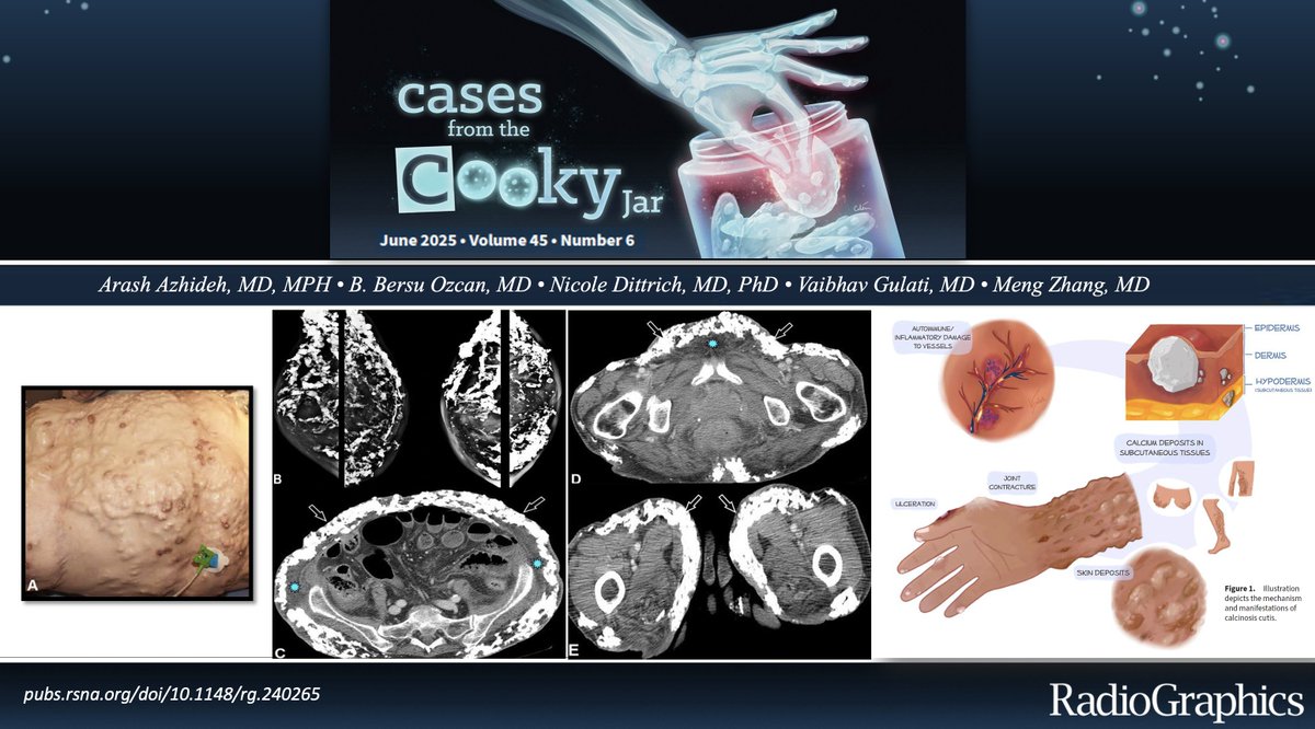 Cases From the Cooky Jar (@casescookyjar) on Twitter photo 45F presents with multiple skin lesions 🩹
What’s the diagnosis ❓🤔
Answer: 🔗 pubs.rsna.org/doi/10.1148/rg…
Have a companion case? Share using #CookyBites #214. We will RT the best cases!
#RGphx <a href="/cookyscan1/">Cooky Menias</a> <a href="/RadioGraphics/">RadioGraphics</a> 45F presents with multiple skin lesions 🩹
What’s the diagnosis ❓🤔
Answer: 🔗 pubs.rsna.org/doi/10.1148/rg…
Have a companion case? Share using #CookyBites #214. We will RT the best cases!
#RGphx <a href="/cookyscan1/">Cooky Menias</a> <a href="/RadioGraphics/">RadioGraphics</a>