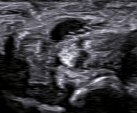 Weakness of thumb opposition after penetrating injury-  nerve ultrasound, revealing fascicular disruption of median nerve.
Nerve US = powerful, accessible tool for post-traumatic neuropathy. #MEDed #RADed #FOAMed #FOAMrad #radres #radiology