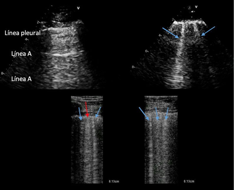 RevistaRetic (@revistaretic) on Twitter photo "Introducción a la ecografía pulmonar para cardiólogos"
!Qué buena revisión, en nuestro nuevo numero!
imagenretic.org/RevEcocarPract…
<a href="/MAecocardio/">MA Garcia Fernandez</a> <a href="/epozoosinalde/">Eduardo Pozo</a> <a href="/josejgdnews/">Jose Juan Gomez</a> <a href="/Azcarate_Cardio/">Doctor Pedro Azcárate</a> <a href="/javierurmeneta1/">Javier Urmeneta</a> <a href="/CardioCecconi/">Alberto Cecconi</a> <a href="/rafavidalperez/">rafavidalperez</a> <a href="/chileanestesia/">Editora Revista Chilena de Anestesia</a> "Introducción a la ecografía pulmonar para cardiólogos"
!Qué buena revisión, en nuestro nuevo numero!
imagenretic.org/RevEcocarPract…
<a href="/MAecocardio/">MA Garcia Fernandez</a> <a href="/epozoosinalde/">Eduardo Pozo</a> <a href="/josejgdnews/">Jose Juan Gomez</a> <a href="/Azcarate_Cardio/">Doctor Pedro Azcárate</a> <a href="/javierurmeneta1/">Javier Urmeneta</a> <a href="/CardioCecconi/">Alberto Cecconi</a> <a href="/rafavidalperez/">rafavidalperez</a> <a href="/chileanestesia/">Editora Revista Chilena de Anestesia</a>