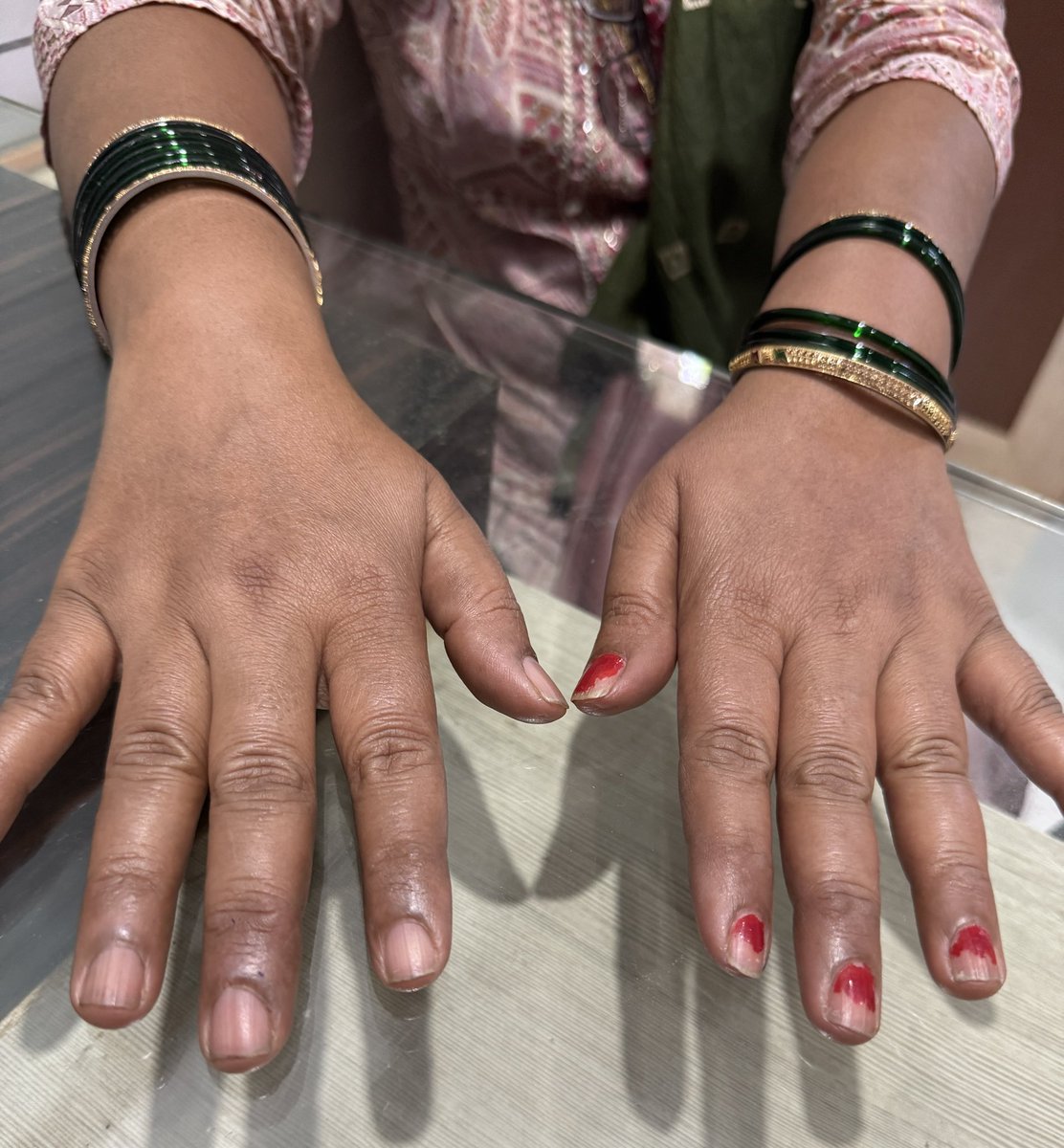 Rheumatoid arthritis since last 10 years. Tried every possible method of treatment. Results not satisfactory. Two years with proteins rich diet. No more flare ups of RA!
“Sugar,wheat and fried foods are enemies of rheumatoid arthritis”
Do try it for 90 days and see the