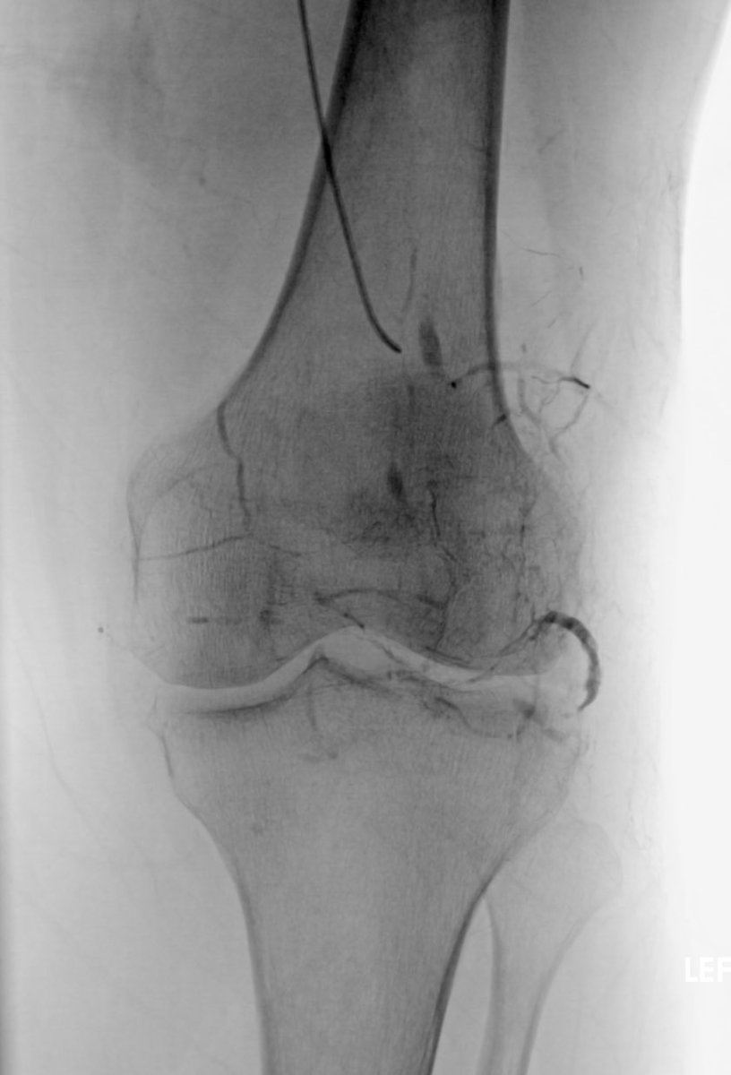 Osman Ahmed (@therealdoctoros) on Twitter photo GAE 🚨 Marked synovitis from the ILGA with prolonged and continued uptake of lipio-joint into the synovium on “delayed” phases - is this the new cTACE 🤔 <a href="/kavikrishVIR/">Venkatesh (Kavi) Krishnasamy</a> #irad 🦴 GAE 🚨 Marked synovitis from the ILGA with prolonged and continued uptake of lipio-joint into the synovium on “delayed” phases - is this the new cTACE 🤔 <a href="/kavikrishVIR/">Venkatesh (Kavi) Krishnasamy</a> #irad 🦴