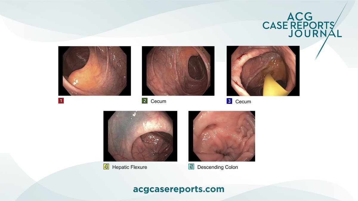 ACGCRJ (@acgcrj) on Twitter photo 🔎 ACG Case Reports Journal 🔍
Avoiding Premature Antibiotic Use in Recurrent Clostridioides difficile Infection After Fecal Microbiota Transplant
Burdette, et al.
👉 bit.ly/3ESZDVl
<a href="/PrateekHarne1/">Prateek Harne MBBS, MD</a> <a href="/NadeemYousafMD/">Nadeem Yousaf</a> 🔎 ACG Case Reports Journal 🔍
Avoiding Premature Antibiotic Use in Recurrent Clostridioides difficile Infection After Fecal Microbiota Transplant
Burdette, et al.
👉 bit.ly/3ESZDVl
<a href="/PrateekHarne1/">Prateek Harne MBBS, MD</a> <a href="/NadeemYousafMD/">Nadeem Yousaf</a>