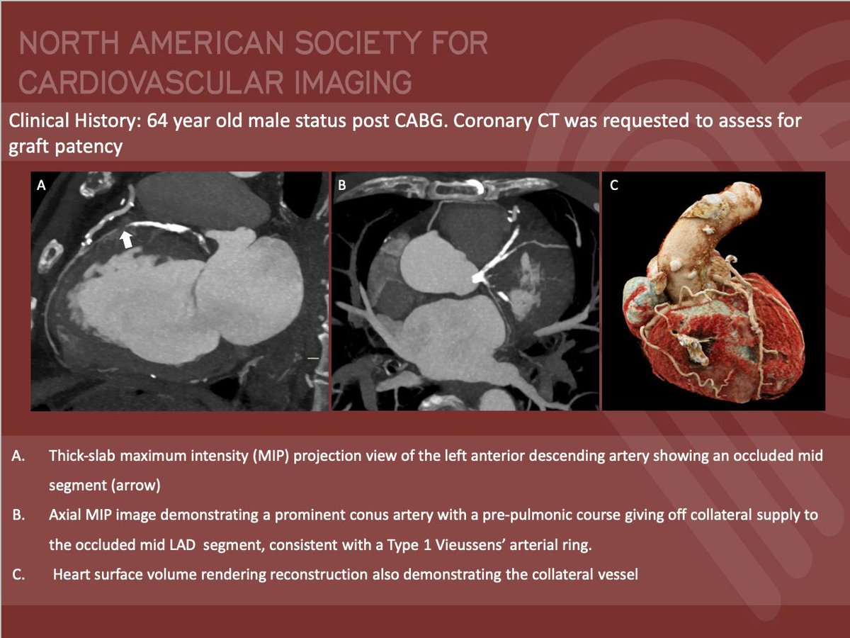 NASCI (@nascisociety) on Twitter photo #NASCI Case Series
Case 75
Courtesy of Jerald S. Lim <a href="/jgl_md/">Jerald Lim MD</a> from St. Luke’s Medical Center, Philippines
What is the right answer?
#whyCMR #YesCCT
<a href="/GregKicska/">Gregory Kicska</a> <a href="/JRevRad1/">Jonathan Revels DO, FSAR</a> <a href="/dianalitmano/">diana litmanovich</a> <a href="/DanielVargasMD/">Daniel Vargas, MD</a> <a href="/kirschj/">Jacobo Kirsch, MD, MBA, FACR</a> <a href="/prachipagarwal/">Prachi Agarwal</a> <a href="/AwsHamid5/">Aws Hamid, MD, MS</a> <a href="/EscrOffice/">ESCR Vienna</a> <a href="/CarlottaOnnis/">Carlotta Onnis</a> <a href="/DeCeccoCN/">Carlo N. De Cecco, MD, PhD</a> #NASCI Case Series
Case 75
Courtesy of Jerald S. Lim <a href="/jgl_md/">Jerald Lim MD</a> from St. Luke’s Medical Center, Philippines
What is the right answer?
#whyCMR #YesCCT
<a href="/GregKicska/">Gregory Kicska</a> <a href="/JRevRad1/">Jonathan Revels DO, FSAR</a> <a href="/dianalitmano/">diana litmanovich</a> <a href="/DanielVargasMD/">Daniel Vargas, MD</a> <a href="/kirschj/">Jacobo Kirsch, MD, MBA, FACR</a> <a href="/prachipagarwal/">Prachi Agarwal</a> <a href="/AwsHamid5/">Aws Hamid, MD, MS</a> <a href="/EscrOffice/">ESCR Vienna</a> <a href="/CarlottaOnnis/">Carlotta Onnis</a> <a href="/DeCeccoCN/">Carlo N. De Cecco, MD, PhD</a>