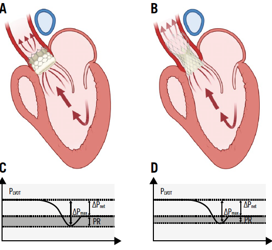 EuroIntervention (@eurointerventio) on Twitter photo This editorial by <a href="/MichaelJoner3/">Michael Joner</a> & <a href="/dmylotte/">Darren Mylotte</a> discusses new insights from van den Dorpel et al. on post-TAVI gradients: invasive >10 mmHg predicts mortality, while echo-derived values may mislead due to pressure recovery. #TAVI #CardioTwitter
ow.ly/25FK50VKCVj This editorial by <a href="/MichaelJoner3/">Michael Joner</a> & <a href="/dmylotte/">Darren Mylotte</a> discusses new insights from van den Dorpel et al. on post-TAVI gradients: invasive >10 mmHg predicts mortality, while echo-derived values may mislead due to pressure recovery. #TAVI #CardioTwitter
ow.ly/25FK50VKCVj
