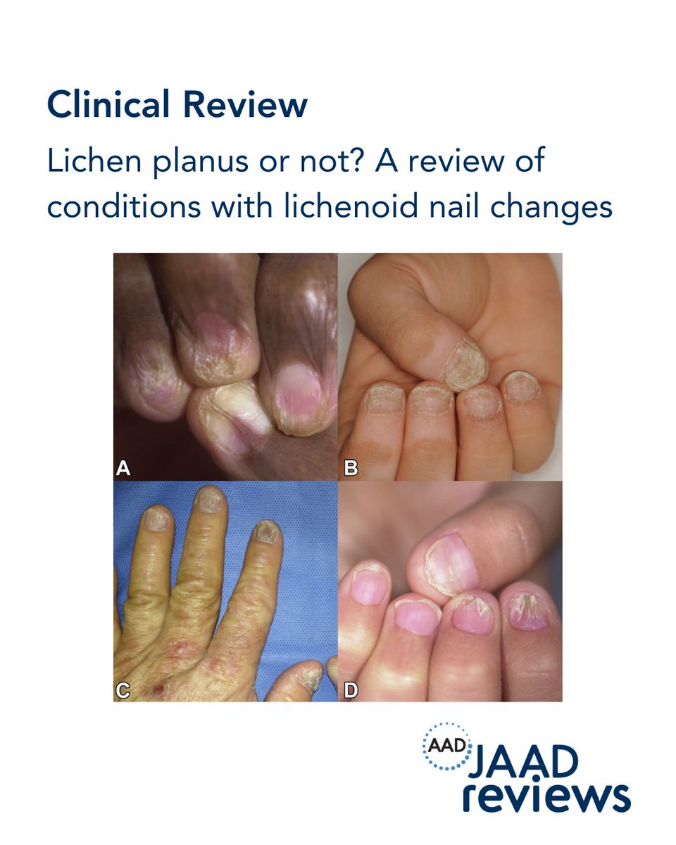 Lichen planus (LP) is a chronic autoimmune disease that can affect nails in up to 15% of cases—often signaling severity. This article in JAAD Reviews looks at lichenoid nail changes and how to recognize them. Read more via the link in our bio: bit.ly/4lyhZLU
