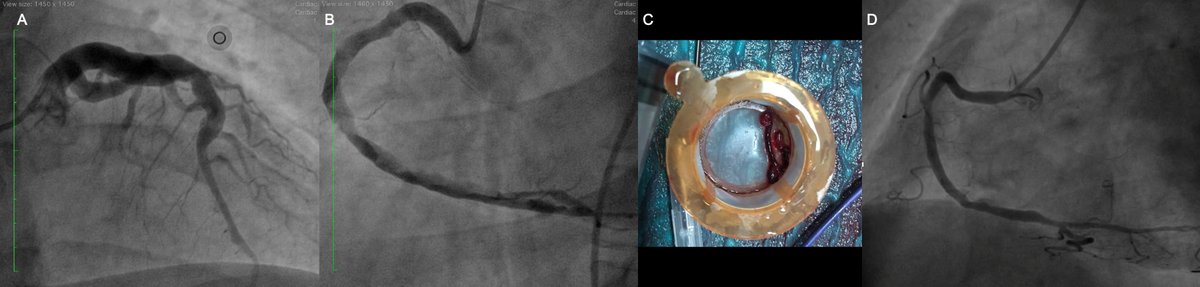 Journal of Invasive Cardiology (@invasivecardiol) on Twitter photo Uncommon Etiology of ST-elevation Myocardial Infarction: Behçet's Disease-Induced Coronary Aneurysm ➡️
hubs.ly/Q03jVV4S0
<a href="/DLBHATTMD/">Dr. Deepak L. Bhatt</a> #cardioTwitter #cardioX #cardiology #interventionalcardiology Uncommon Etiology of ST-elevation Myocardial Infarction: Behçet's Disease-Induced Coronary Aneurysm ➡️
hubs.ly/Q03jVV4S0
<a href="/DLBHATTMD/">Dr. Deepak L. Bhatt</a> #cardioTwitter #cardioX #cardiology #interventionalcardiology