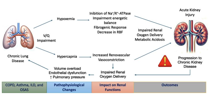 Now open access in <a href="/NDTsocial/">NDT</a>

Chronic lung diseases and kidney disease: pathophysiology and management 

🧐Hypoxemia and hypercapnia contribute to kidney hypoperfusion, endothelial dysfunction, and sodium-water imbalances, exacerbating renal injury

▶️academic.oup.com/ndt/article/do…