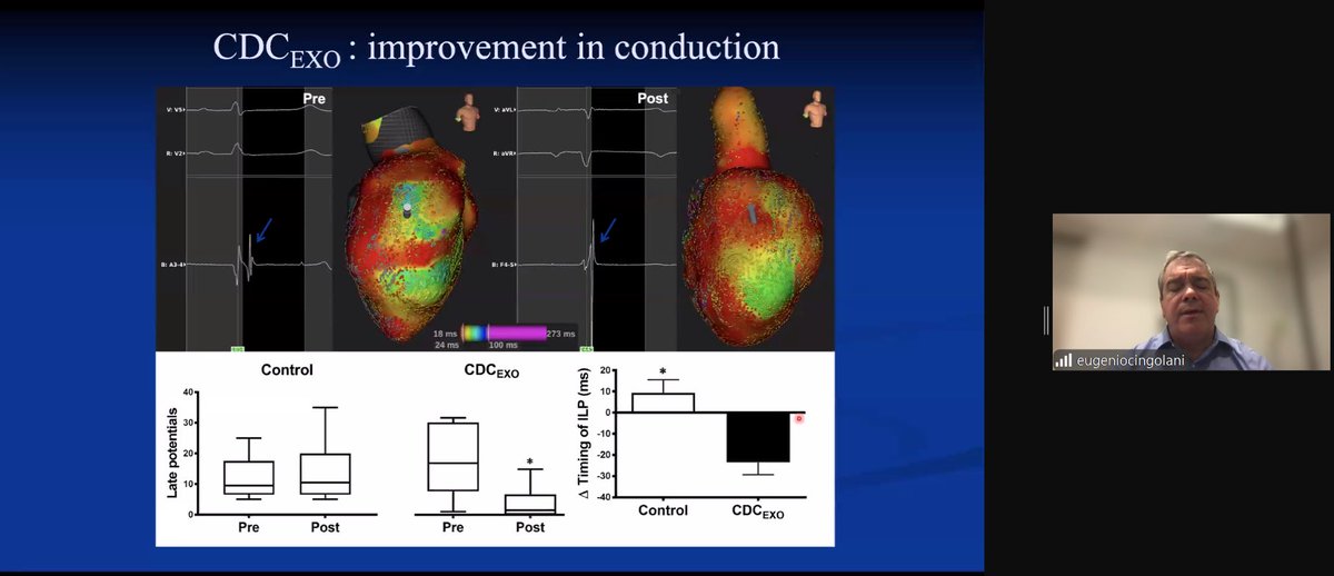 Ana Iribarren, MD (@anairibarren10) on Twitter photo New Ways to Tackle Ventricular Arrhythmias. <a href="/EugenioCingolan/">Eugenio Cingolani, MD</a> talking about what’s changing at <a href="/hopkinsheart/">Johns Hopkins Cardiology</a>
<a href="/SmidtHeart/">Smidt Heart Institute at Cedars-Sinai</a> <a href="/CedarsSinaiMed/">Cedars-Sinai Academic Medicine</a> New Ways to Tackle Ventricular Arrhythmias. <a href="/EugenioCingolan/">Eugenio Cingolani, MD</a> talking about what’s changing at <a href="/hopkinsheart/">Johns Hopkins Cardiology</a>
<a href="/SmidtHeart/">Smidt Heart Institute at Cedars-Sinai</a> <a href="/CedarsSinaiMed/">Cedars-Sinai Academic Medicine</a>