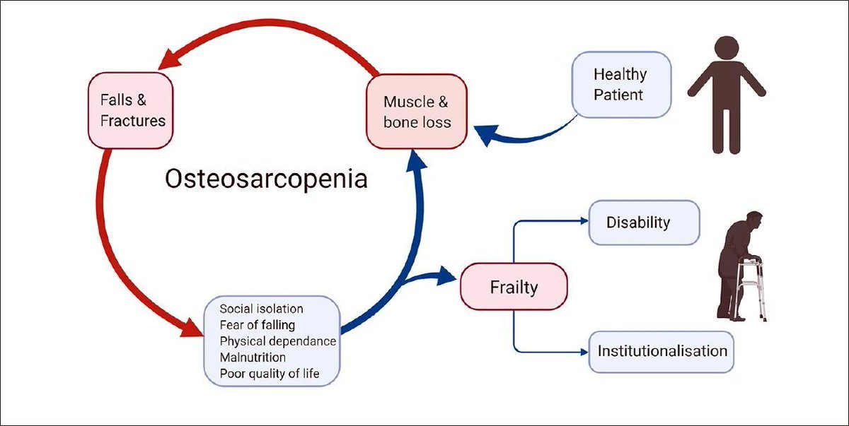 Hoy en #Difundiendo_con_hueso🦴, tras el parón volvemos con la #osteosarcopenia. Alta prevalencia tras #Hip #fracture, hace necesario su valoración (#sarcopenia #OS) en las #FLS.

rdcu.be/ej45p de <a href="/BioMedCentral/">BMC</a> 😁

Buen miércoles