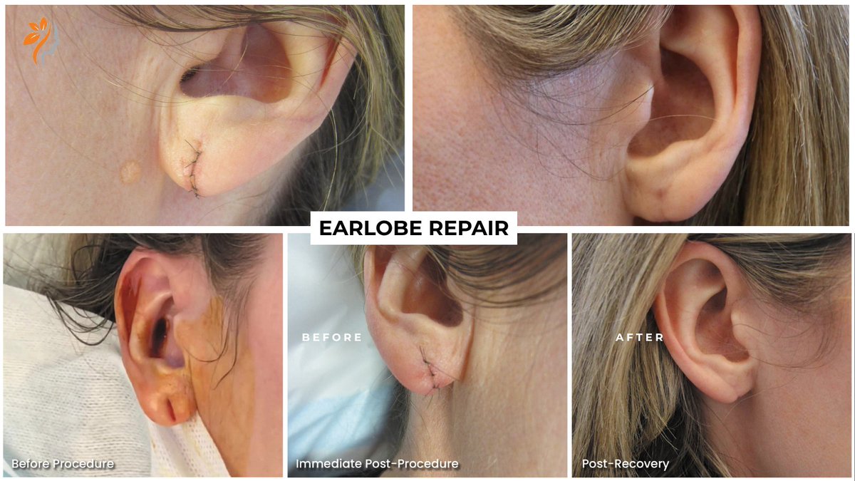 Whether your tear is partial or complete, recent or old, our expert #plasticsurgeon, Dr. Robert Backstein, can restore your #earlobe with a quick, 20-minute procedure that requires no downtime and causes minimal discomfort. torontodermatologycentre.com/book-now/