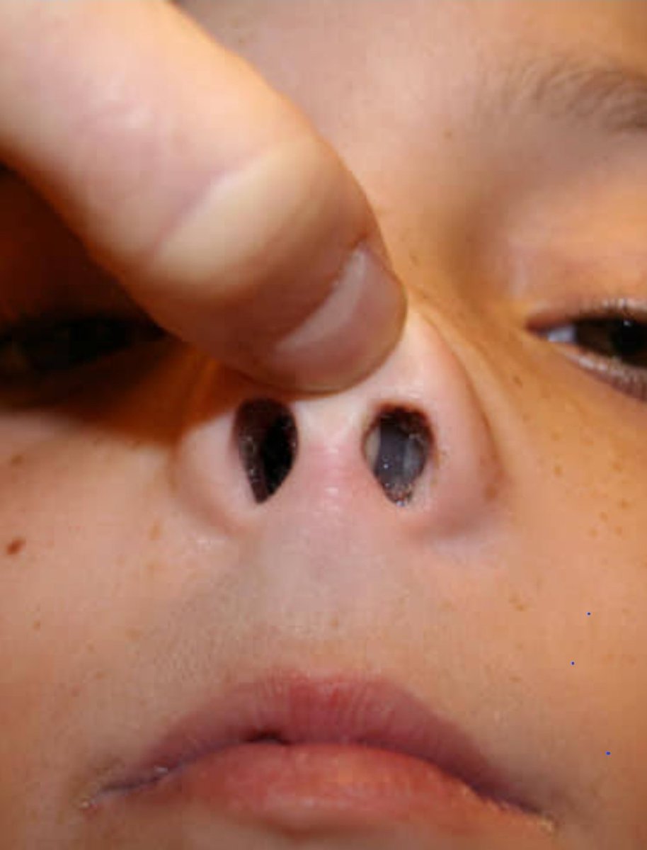 FAHAMU UGONJWA WA NYAMA ZINAZOOTA PUANI (NASAL POLYPS )  NA TIBA YAKE .

Hizi ni vimbe zinazojitokeza toka katika kiwambo ute ndani Ya Pua na paranasal sinuses (Aina Ya Vitundu Ndani Ya Pua ). 👇📍