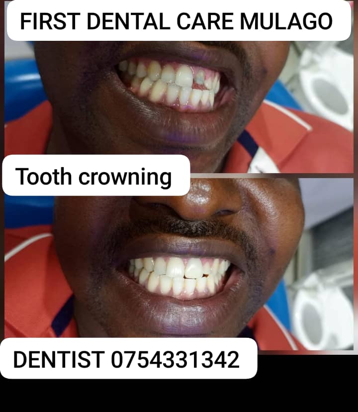 Tooth crowning