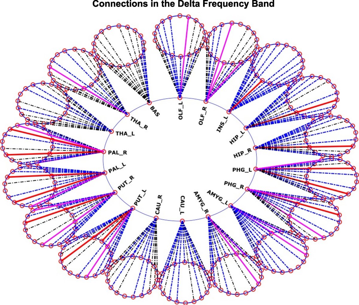 Journal of Clinical Neurophysiology (@jclinneurophys) on Twitter photo Chirumamilla et al used high-density #EEG in 112 low-risk full term newborns and assessed partial directed coherence in the delta frequency band between left and right hemispheres.  Check it out! 👶🧠⚡bit.ly/3EekOAY <a href="/ACNS_org/">ACNS</a> Chirumamilla et al used high-density #EEG in 112 low-risk full term newborns and assessed partial directed coherence in the delta frequency band between left and right hemispheres.  Check it out! 👶🧠⚡bit.ly/3EekOAY <a href="/ACNS_org/">ACNS</a>