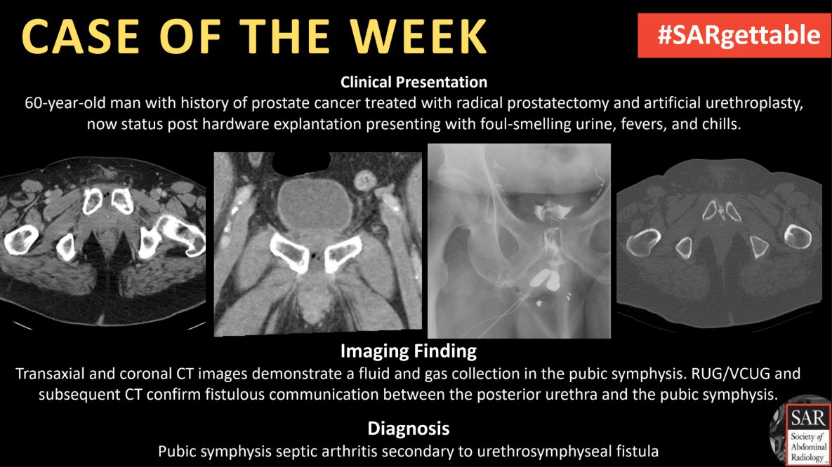 Society of Abdominal Radiology | SAR (@societyabdrad) on Twitter photo The answer to last week's #SARgettable Case of the Week, contributed by <a href="/danielfriedman/">danielfriedman</a>, <a href="/MIRimaging/">WashUMedMIR</a> and <a href="/ItaniMalak/">Malak Itani</a>, is: Pubic symphysis septic arthritis secondary to urethrosymphyseal fistula. Thanks for playing! The answer to last week's #SARgettable Case of the Week, contributed by <a href="/danielfriedman/">danielfriedman</a>, <a href="/MIRimaging/">WashUMedMIR</a> and <a href="/ItaniMalak/">Malak Itani</a>, is: Pubic symphysis septic arthritis secondary to urethrosymphyseal fistula. Thanks for playing!