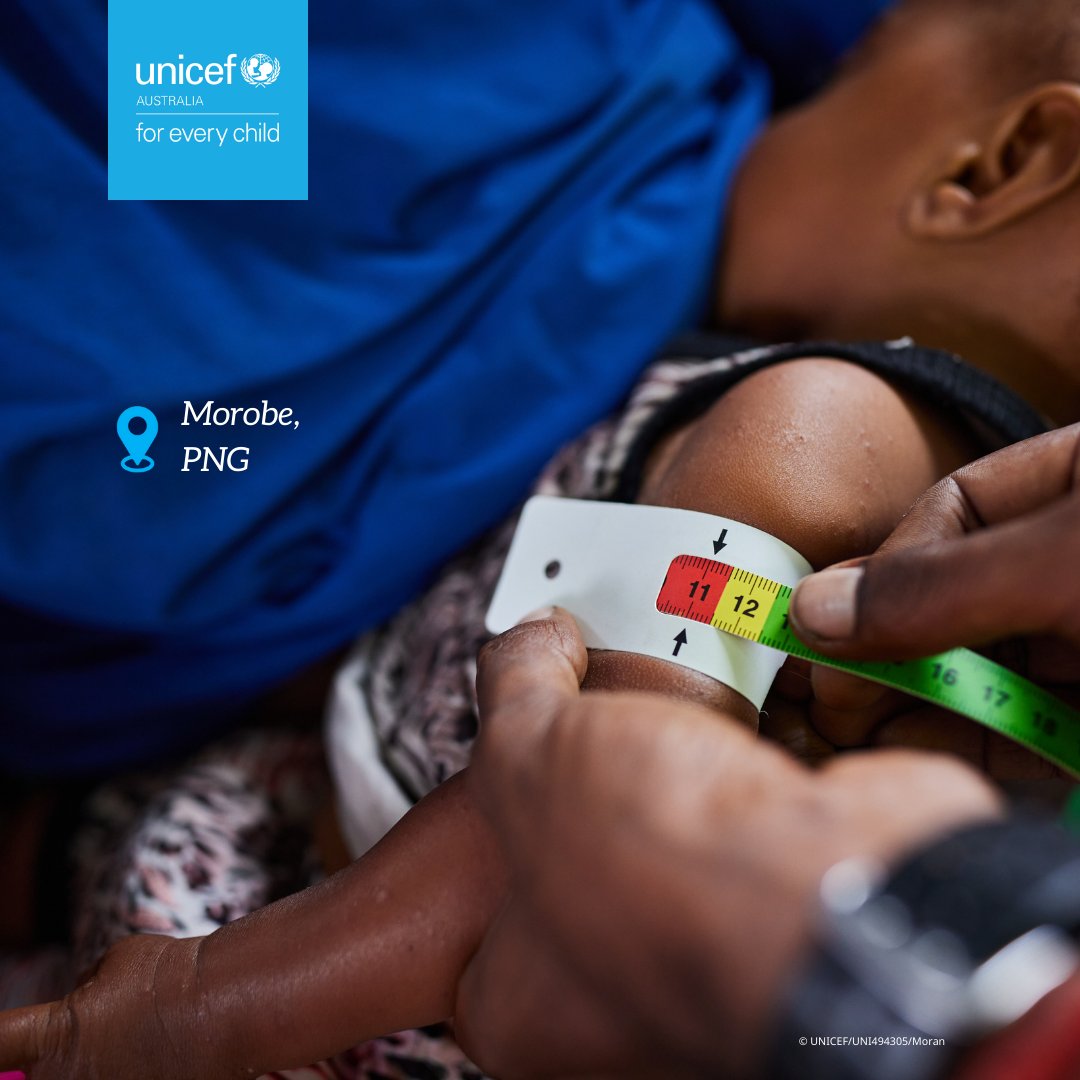 UNICEF Australia (@unicefaustralia) on Twitter photo Little Jeremaiah is at a UNICEF-supported healthcare clinic for the first time, receiving treatment for severe acute malnutrition. We’re working with partners to make a difference for remote communities, so that every child is healthy.
This program is supported by <a href="/dfat/">Department of Foreign Affairs and Trade 🇦🇺</a> #ANCP Little Jeremaiah is at a UNICEF-supported healthcare clinic for the first time, receiving treatment for severe acute malnutrition. We’re working with partners to make a difference for remote communities, so that every child is healthy.
This program is supported by <a href="/dfat/">Department of Foreign Affairs and Trade 🇦🇺</a> #ANCP