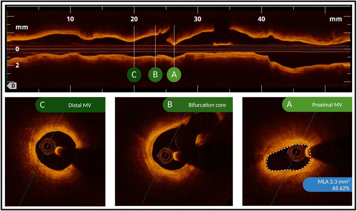 REC Publications (@revespcardiol) on Twitter photo Fractional flow reserve or OCT to guide management of complex and noncomplex angiographically intermediate coronary stenosis #REC #AheadOfPrint <a href="/AndreaZito66/">Andrea Zito</a> <a href="/BURZOTTA_F/">FRANCESCO BURZOTTA</a>. revespcardiol.org/en-fractional-… Fractional flow reserve or OCT to guide management of complex and noncomplex angiographically intermediate coronary stenosis #REC #AheadOfPrint <a href="/AndreaZito66/">Andrea Zito</a> <a href="/BURZOTTA_F/">FRANCESCO BURZOTTA</a>. revespcardiol.org/en-fractional-…